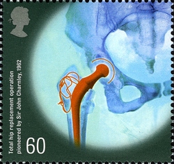Medical Breakthroughs - total Hip replacement operation pioneered by Sir John Charnley 1982