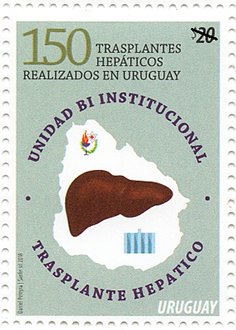 150th Liver Transplant Performed in Uruguay
